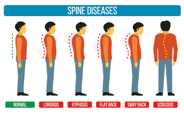 spine diseases graphic