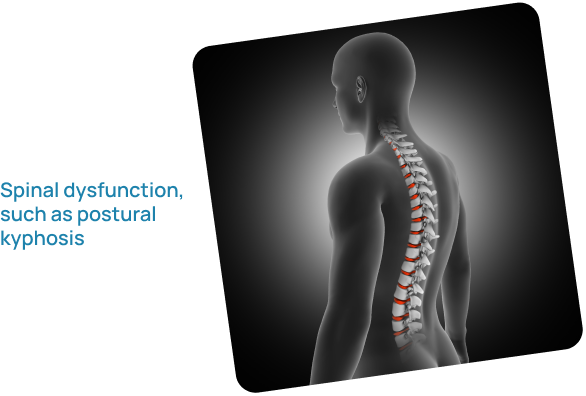 Spinal dysfunction, such as postural kyphosis
