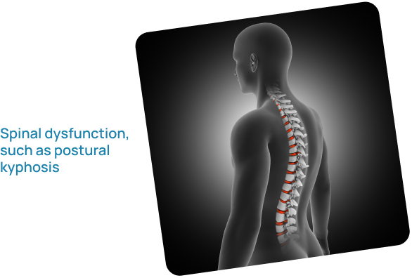 Spinal dysfunction, such as postural kyphosis